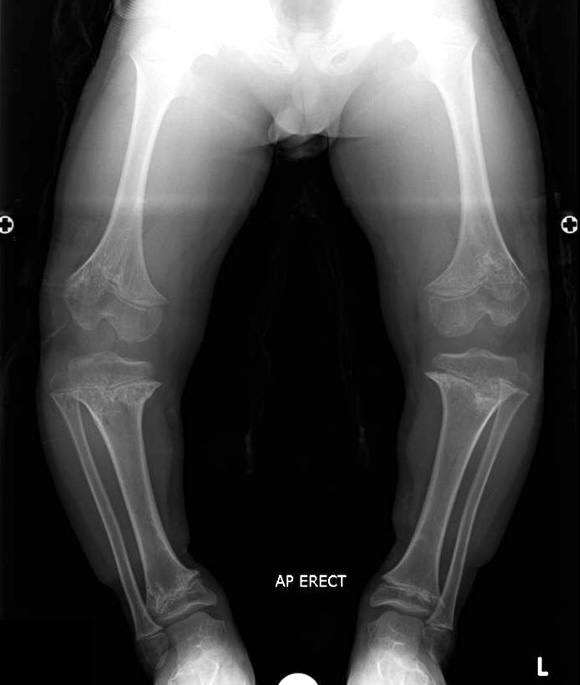achondroplasia