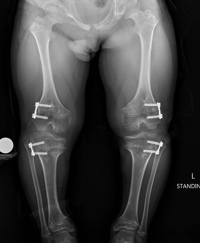 Achondroplasia