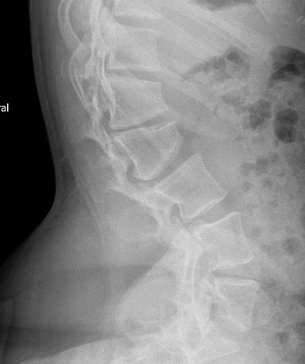 spinal stenosis