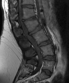 Spinal stenosis
