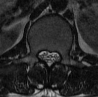 achondroplasia