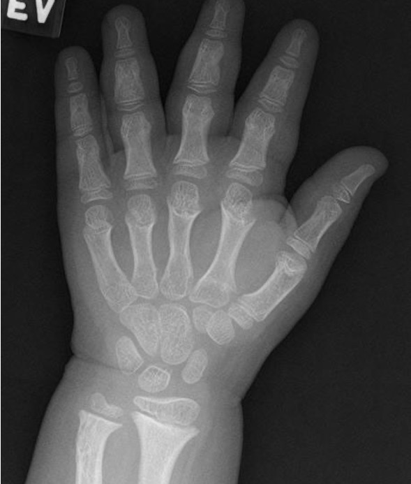 Achondroplasia