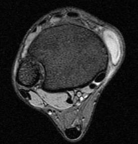 ankle ganglion