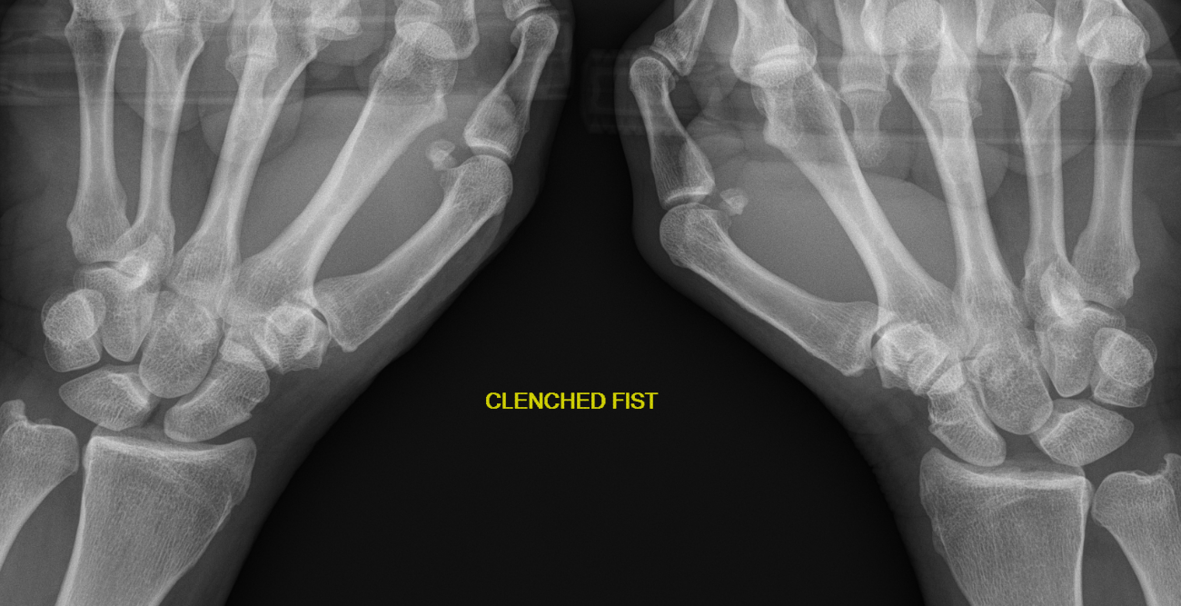 clenched fist
