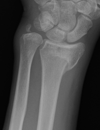 osteotomy