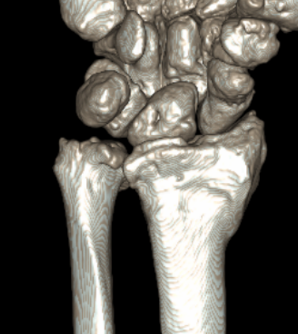 malunion