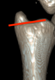 Ulna styloid