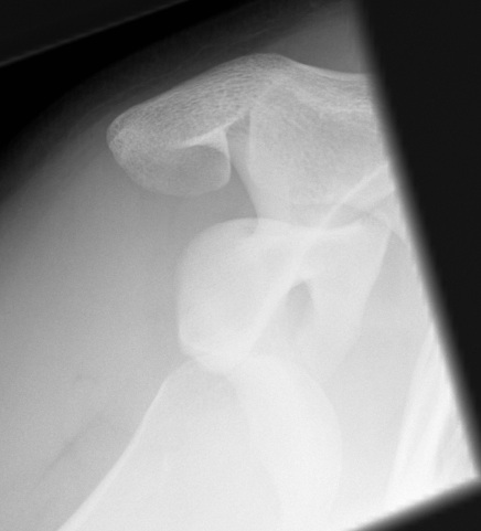 Anterior shoulder dislocation