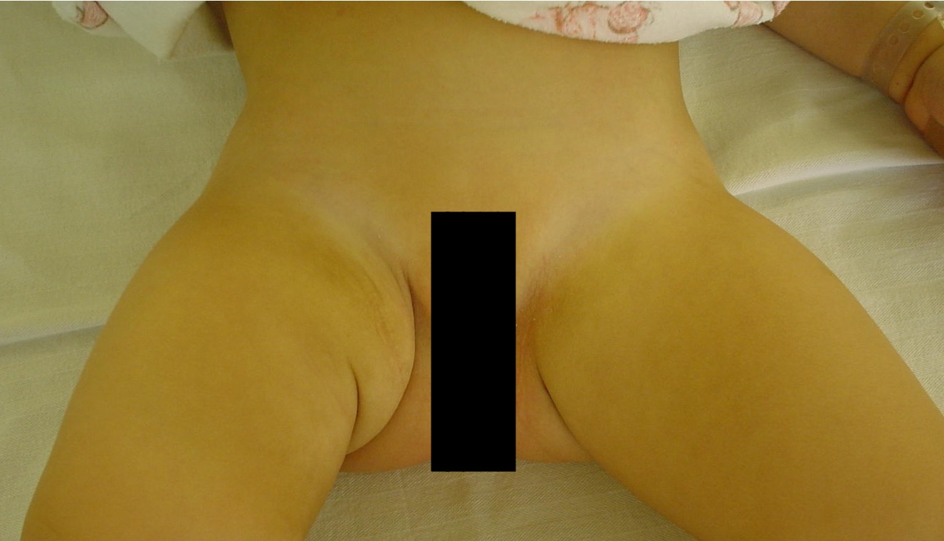 asym crease