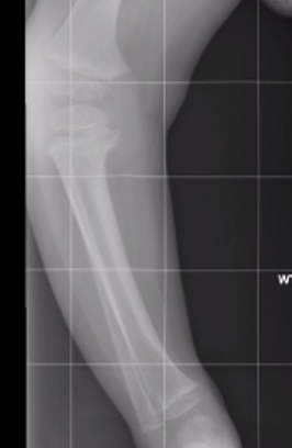 Blounts osteotomy