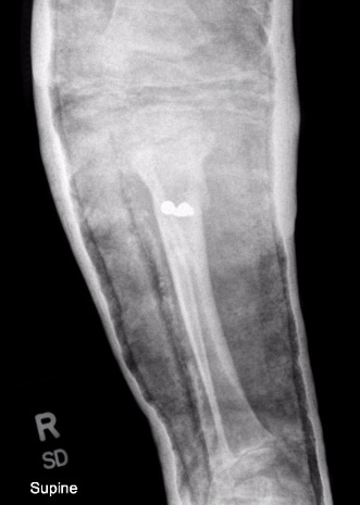 Blounts osteotomy