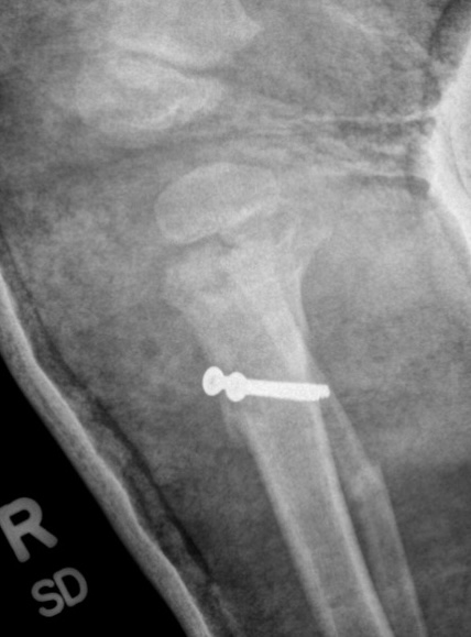 Blounts osteotomy
