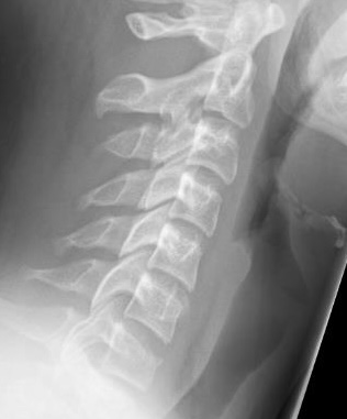 C7 wedge fracture