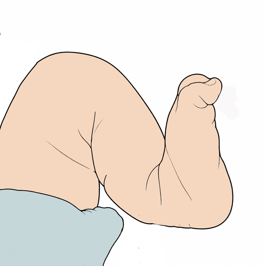 Calcaneovalgus