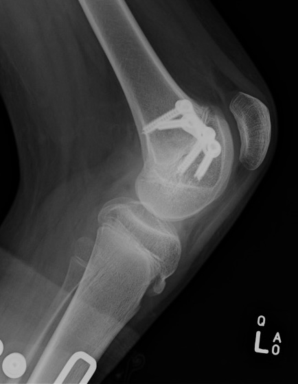 CP knee