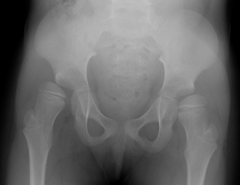 CP hip