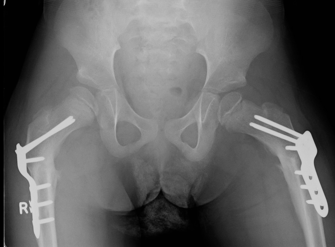 CP hip