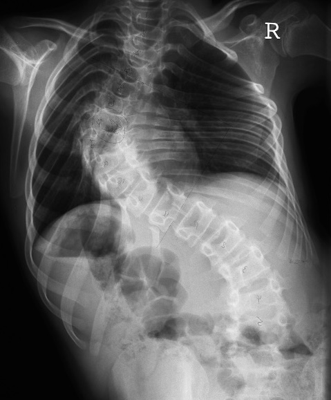 CP spine