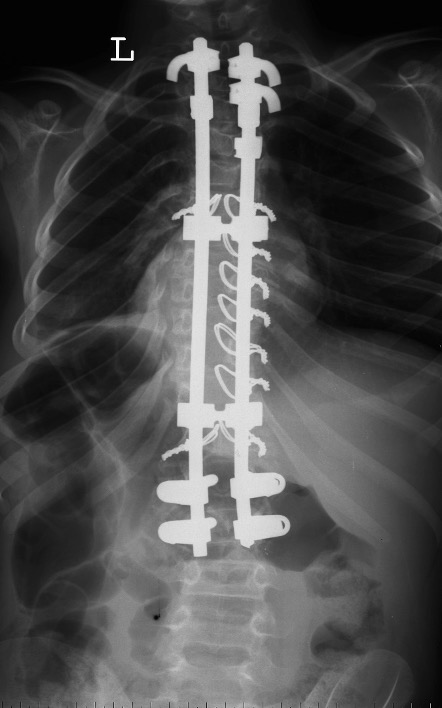CP spine