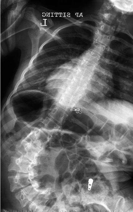 CP scoliosis