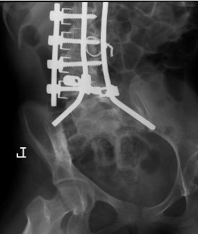 CP spine