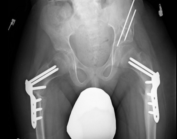 CP hip