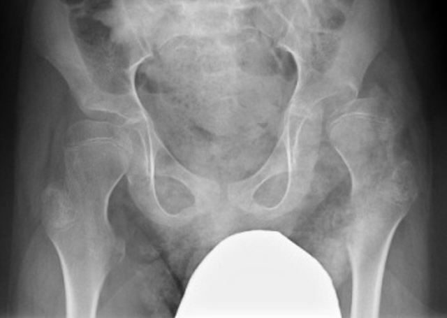 CP hip