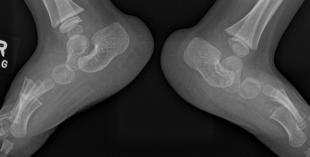 Congential vertical talus bilateral
