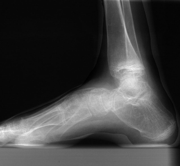 calcaneocavus