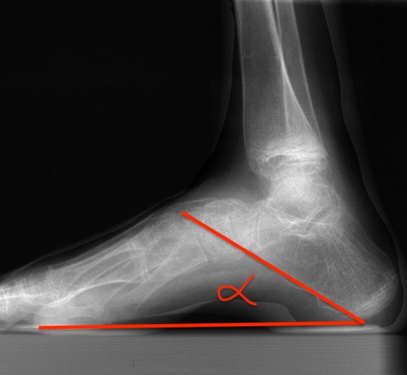 calcaneal pitch