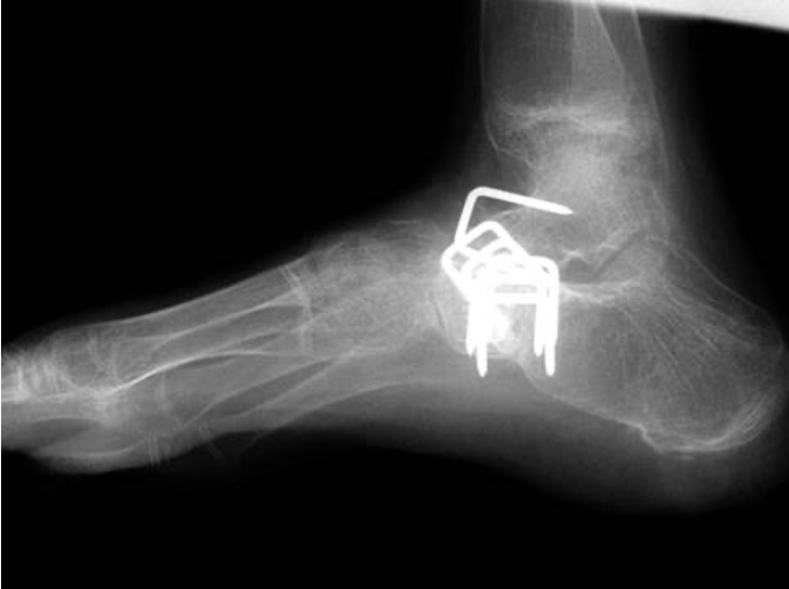 calcaneocavus
