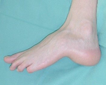 calcaneocavus