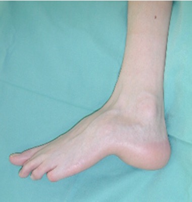 calcaneocavus