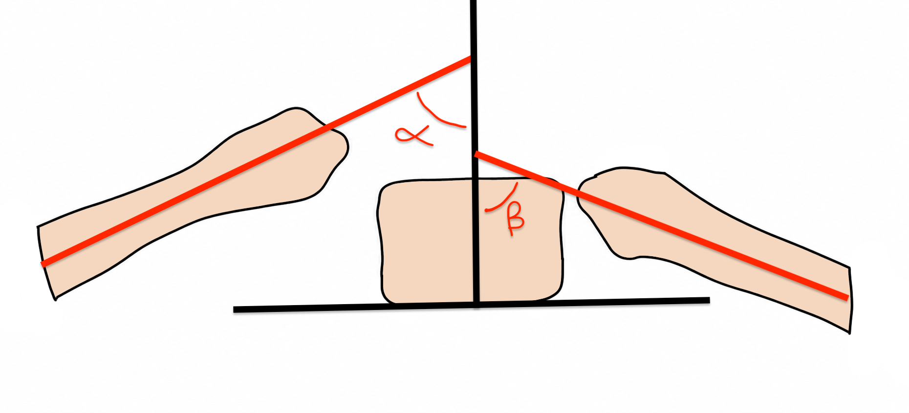 Rib Vertebral angle