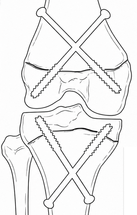 Transphyseal screws