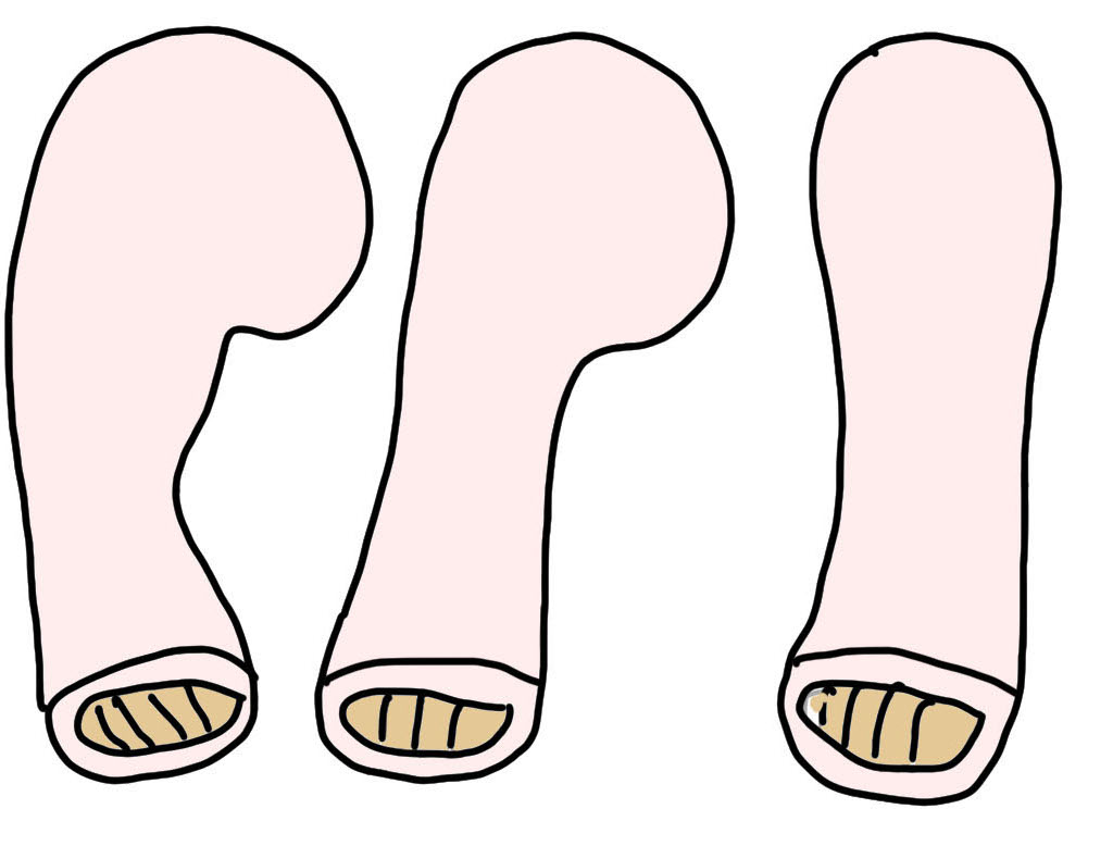 Ponseti