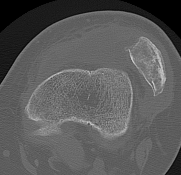 patella 