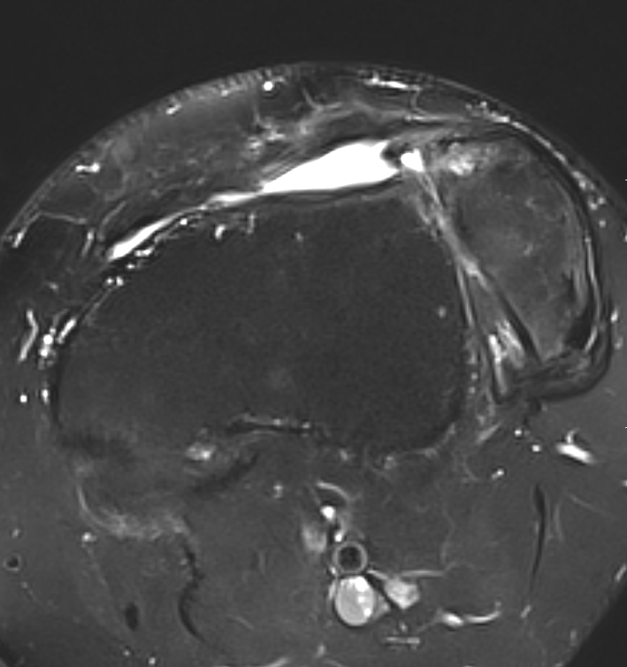 patella