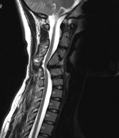 Congenital kyphosis