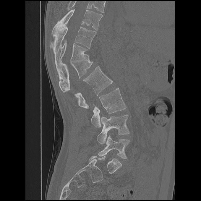 Congential kyphosis