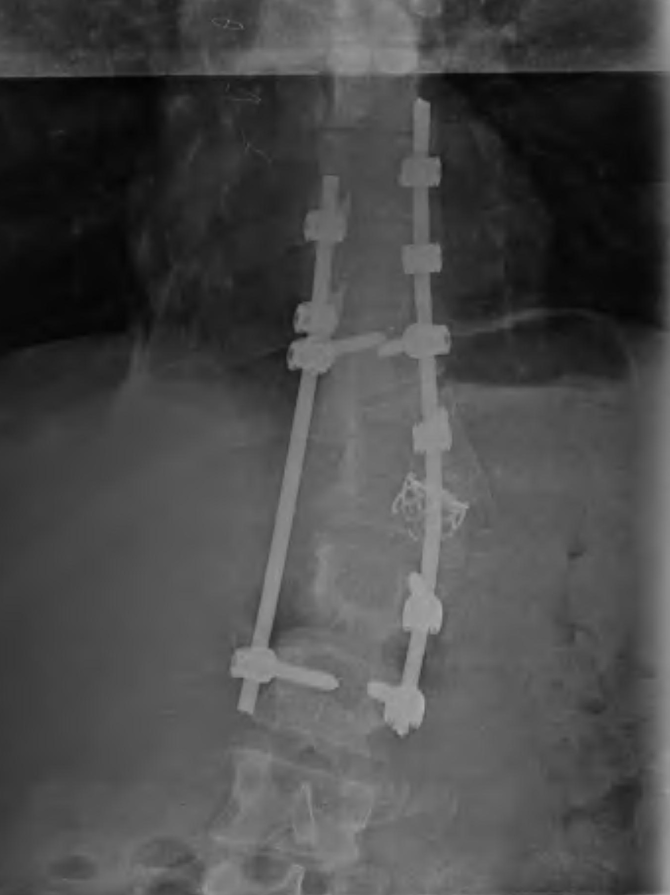 Congenital kyphosis