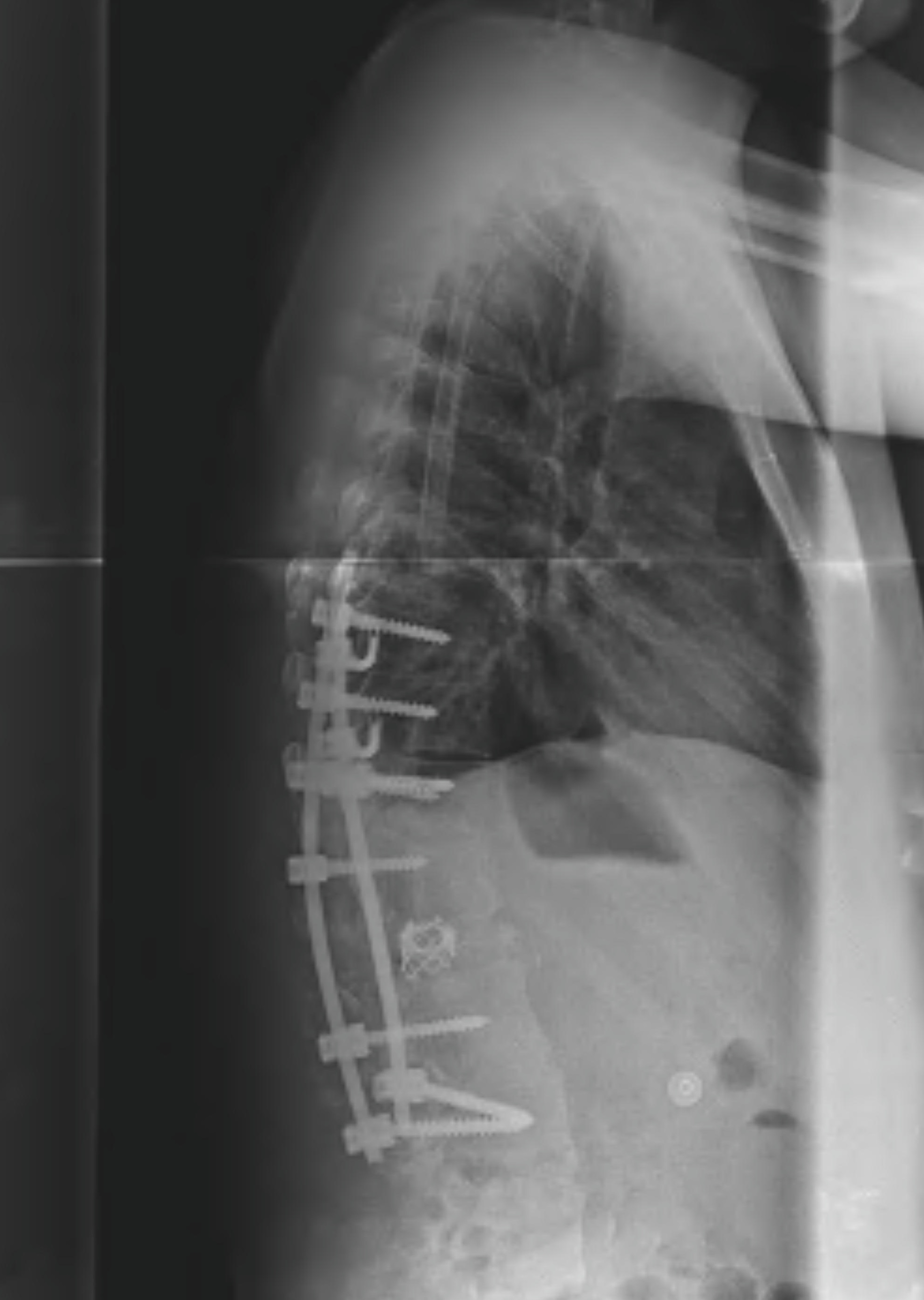 Congential kyphosis