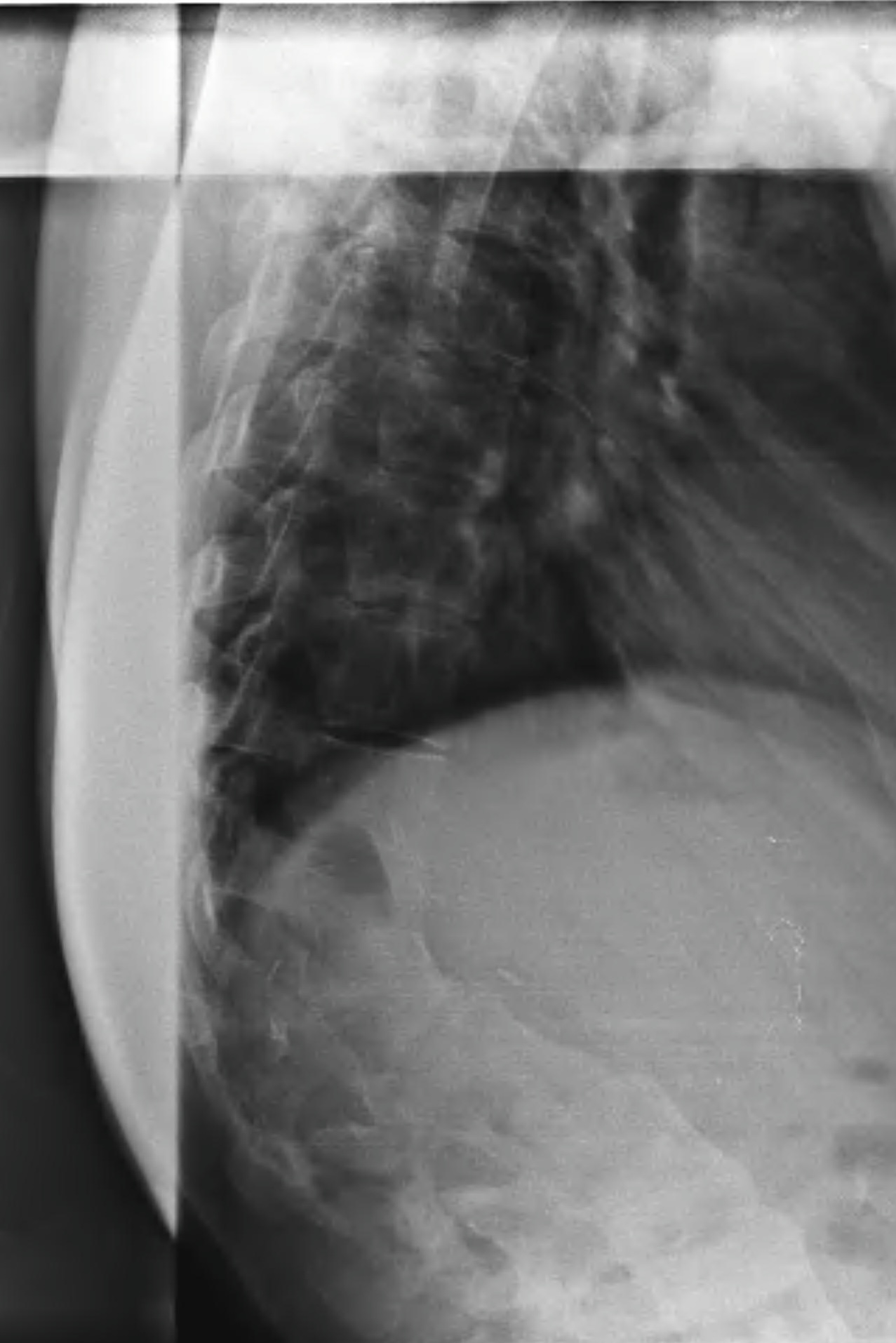Congenital kyphosis
