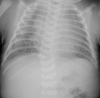 Congential scoliosis