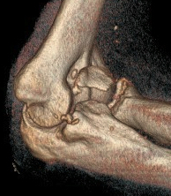 coronoid