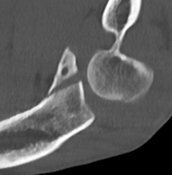 coronoid