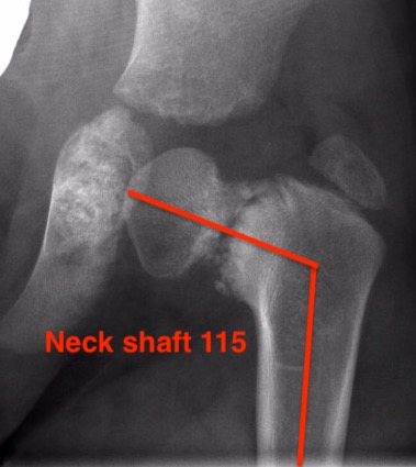 Neck shaft