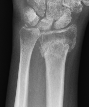malunion