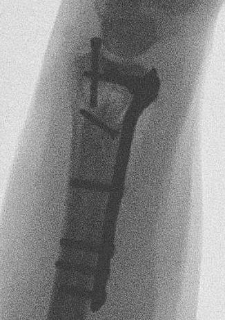 ulna styloid