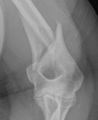 Distal 1/3
